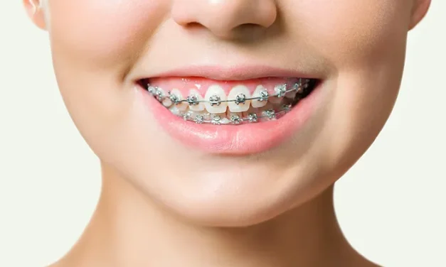 Kawat Gigi Atau Behel Bisa Jadi Style Atau Kesehatan