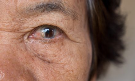 Penyakit Pada Mata Salah Satunya Kondisi Katarak