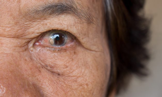 Penyakit Pada Mata Salah Satunya Kondisi Katarak